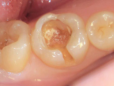 虫歯を少し残した状態